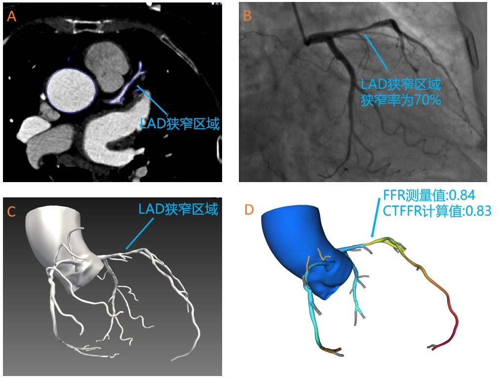 k1体育助力睿心医疗—《冠状动脉供血功能（CT-FFR）评估软件》产品完成创新审评及临床试验